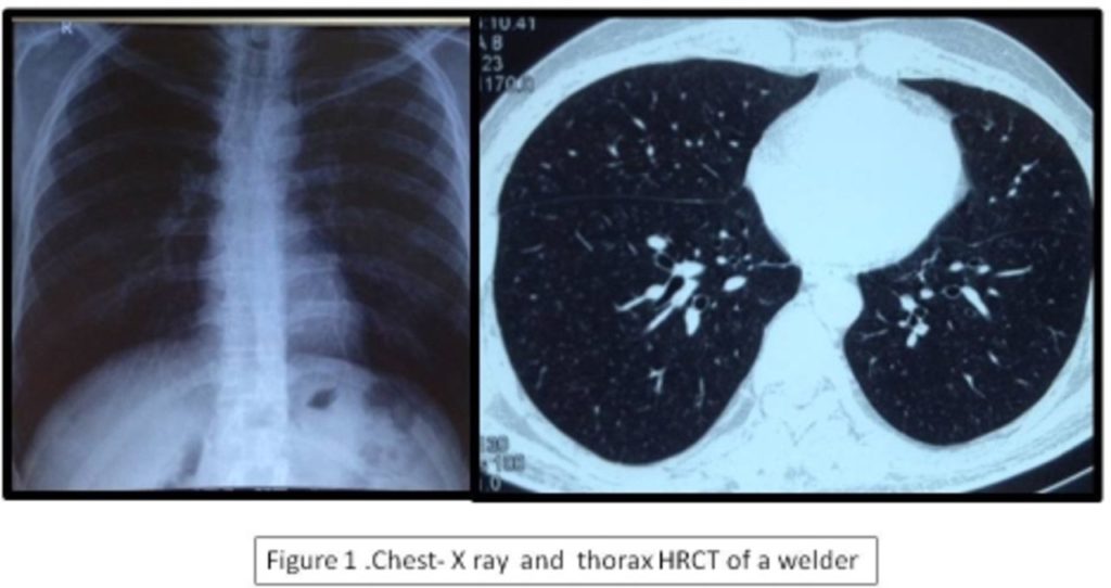 Welders lungs Welders lungs